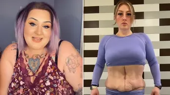 'Massive weight loss patient' describes horror of plastic surgery results, says it looked like a 'hot dog'