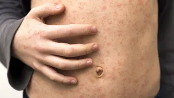 Georgia health officials link third measles case to unvaccinated international traveler