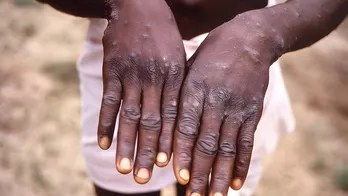 With Mpox a public health emergency in Africa, what you must know about increased virus risk